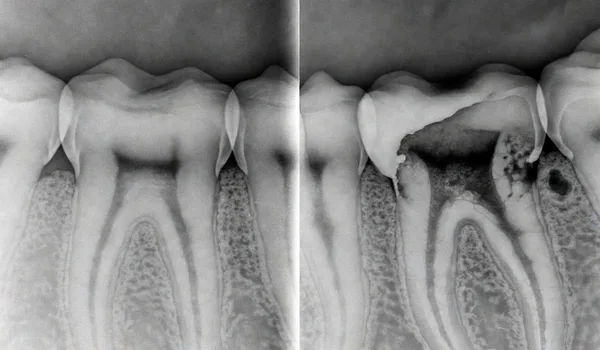 Progression from healthy tooth to cavity to root canal infection