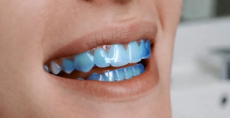 How Long Do Whitening Strips Take to Work