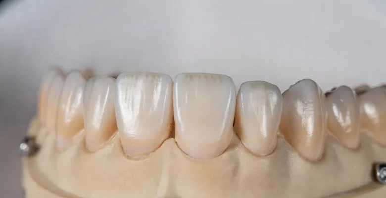 How Much Are Veneers in Mexico