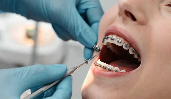 Comparison of braces types showing metal, ceramic, and aligners