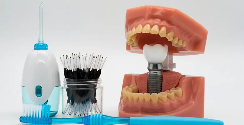 Cleaning All-on-4 Implants