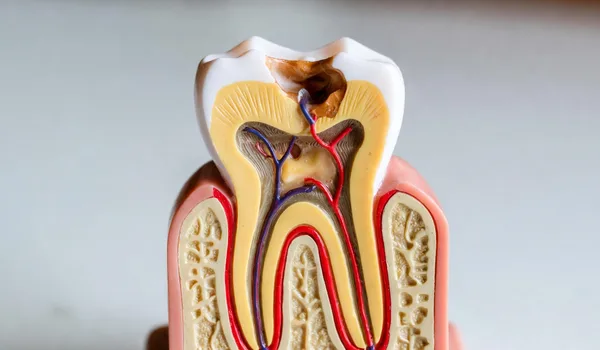 Five stages of tooth decay from white spot to abscess
