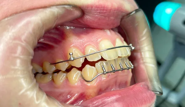 Diagram showing tooth looseness levels from normal to severe