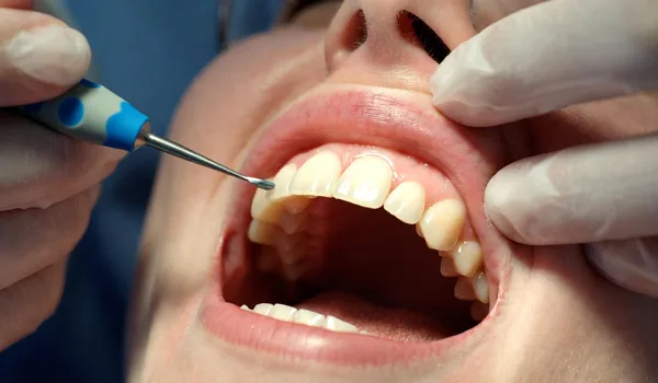 Diagram showing surface stains vs deep discoloration on dental veneers